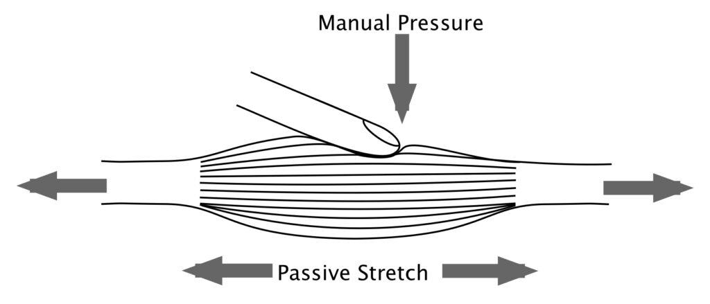 Principle of Therapy - Manual pressure in muscle belly versus stretching